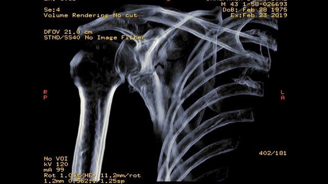 右肩CT显示骨折肩胛骨三维渲染图像视频下载