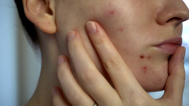 近距离观察皮肤问题(不健康的皮肤如痤疮和丘疹)。治疗问题皮肤。视频素材