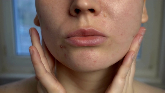近距离观察皮肤问题(不健康的皮肤如痤疮和丘疹)。治疗问题皮肤。视频素材