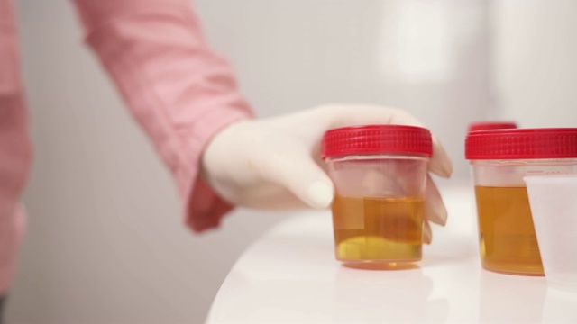 一个特写的手在医用乳胶手套把一个容器与尿样在桌子上视频素材