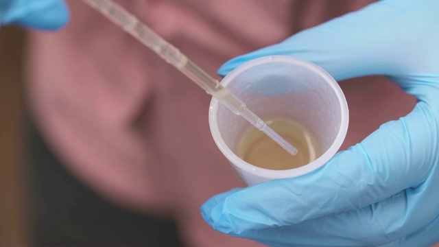 俯视图视频，一只戴着蓝色医用乳胶手套的手从容器中提取尿液样本。视频购买