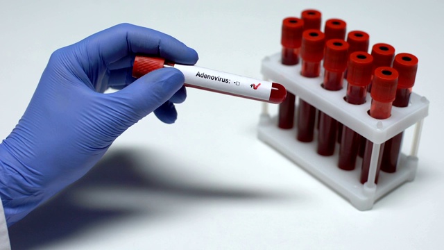 腺病毒试验阳性，医生在试管中发现血液样本，实验室研究视频素材