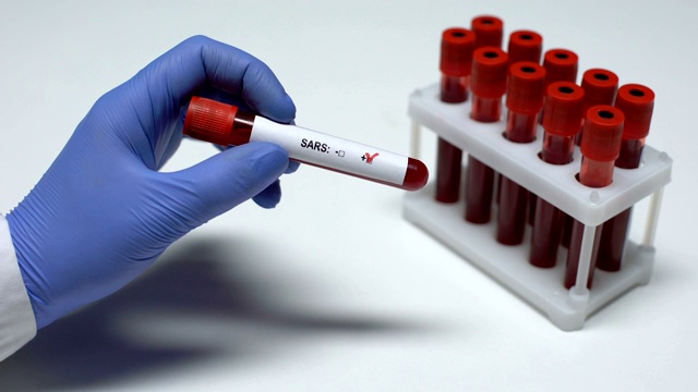 SARS测试呈阳性，医生提供血样，实验室研究，健康检查视频素材