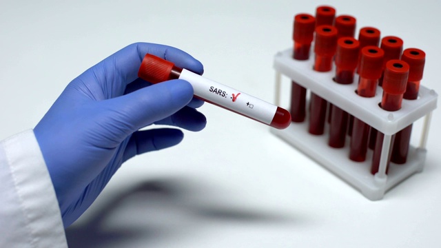 非典型肺炎测试阴性，医生提供血样，实验室研究，健康检查视频素材