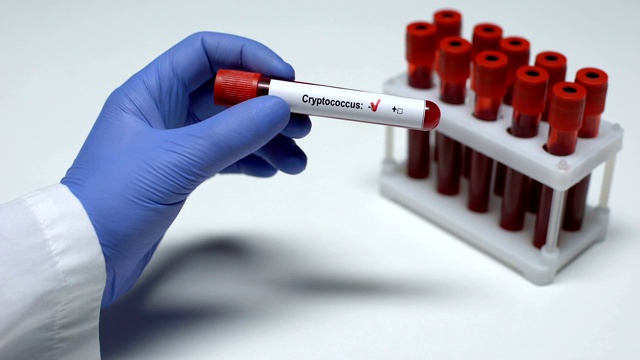 隐球菌试验阴性，医生出示血液样本，健康检查视频下载