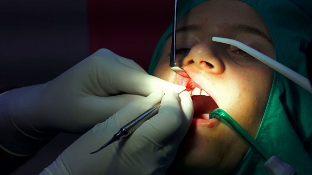 口腔外科手术，cist根尖切除术，暗室手术视频素材