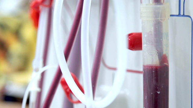 血液透析在人体上的设备视频素材