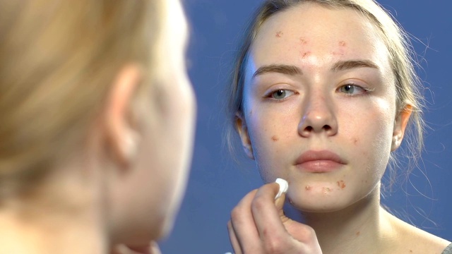 女性青少年应用面部丘疹美容治疗，祛痘护肤视频素材