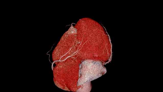 CTA冠状动脉三维渲染图像心脏和血管冠状动脉在屏幕上旋转。视频下载