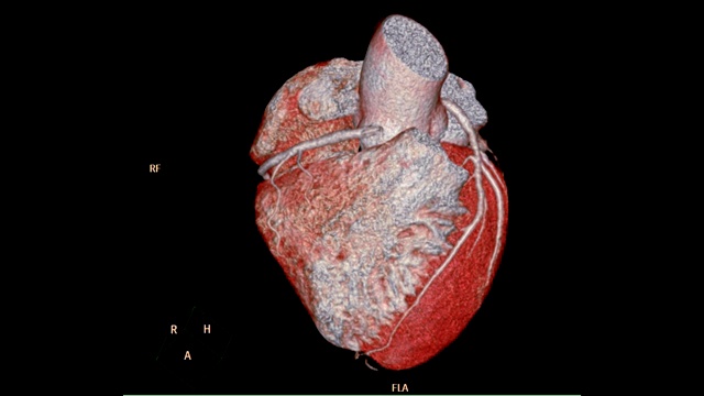 冠状动脉CTA三维成像心脏和血管冠状动脉。视频下载