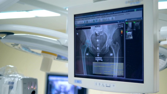 在手术室的屏幕上拍摄病人臀部的x光照片。4 k视频素材