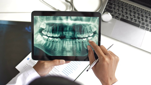 牙科医生在电脑上观察人类牙齿的x光，俯视图视频素材
