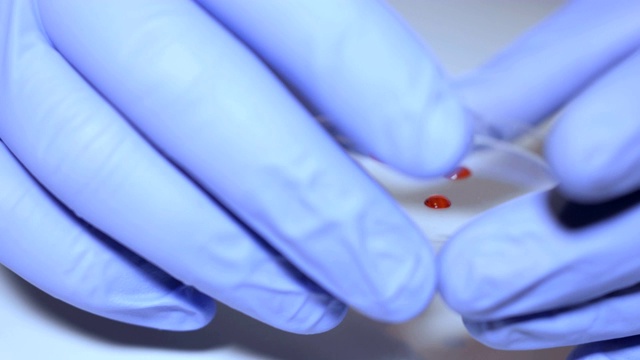 实验室的技术人员拿着移液管检测血液样本在病房进行输血，双手紧闭。医生拿着血液试管的特写。艾滋病/艾滋病毒医院验血。视频素材