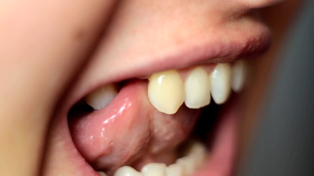 一个女人笑着拔掉了牙齿视频素材