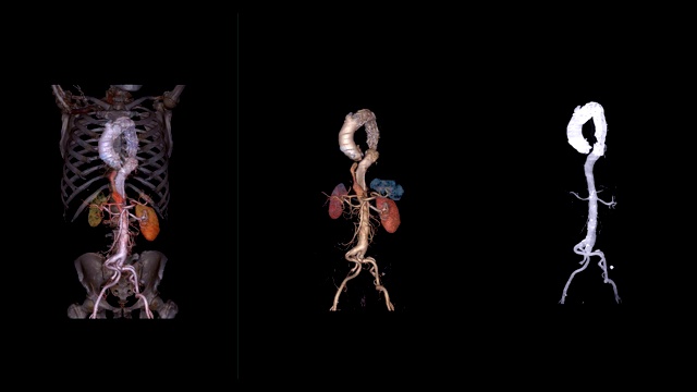 CTA腹主动脉三维渲染图像显示透明的骨骼，3D主动脉和3D主动脉MIP显示主动脉夹层。视频素材