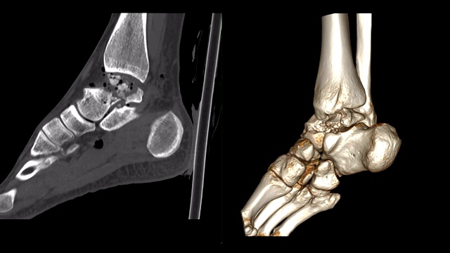 踝关节或右踝关节CT扫描二维矢状面和三维渲染显示骨折距骨。视频素材