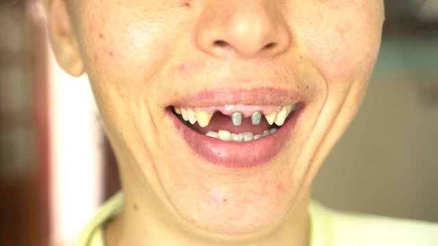假牙科。颌部金属铸造柱、芯及临时冠视频下载