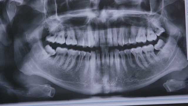 女牙科护士分析牙齿x光影像视频素材