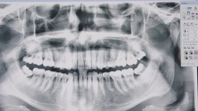 人类牙齿x射线图像的特写屏幕视频素材