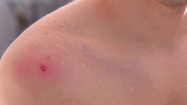 一个男人肩膀上的大红痘痘的特写镜头。男子用手挤痘痘。视频素材