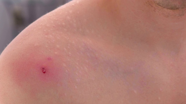 一个男人肩膀上的大红痘痘的特写镜头。男子用手挤痘痘。视频素材