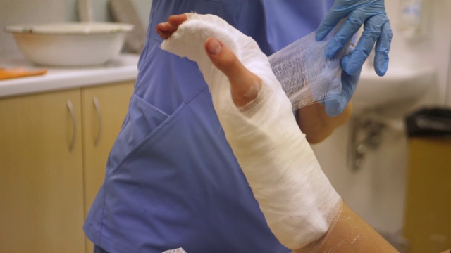 事故后在医院给骨折的手臂上石膏视频素材