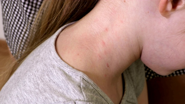 妇女检查儿童皮肤状况。过敏和皮肤病的概念。虫咬视频下载