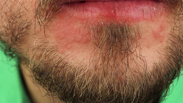 人搔下巴有过敏反应，面部嘴唇附近皮肤发红脱皮银屑病，季节性皮肤病问题，近景宏观视频素材