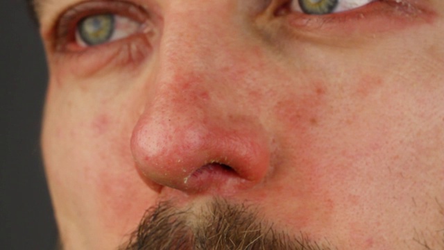 男子搔鼻子有红色过敏反应，面部皮肤发红脱皮银屑病，季节性皮肤病问题，侧面近景宏观视频素材