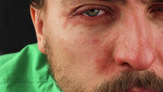 人划伤眼睛有红色过敏反应，面部皮肤发红脱皮银屑病，季节性皮肤病问题，特写视频素材