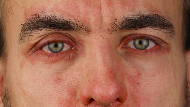 男子眼睛发红有过敏反应和划痕，面部皮肤发红脱皮银屑病，季节性皮肤病问题，特写视频素材