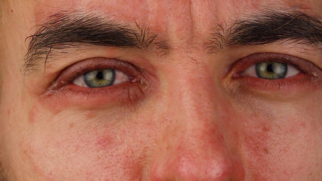 人搔两眼有红色过敏反应，面部皮肤发红脱皮银屑病，季节性皮肤病问题，特写视频素材