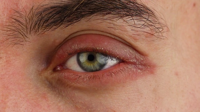 人体左眼抓痕有红色过敏反应，面部皮肤发红脱皮银屑病，季节性皮肤病问题，近景宏观视频素材