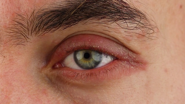 人的左眼抓痕有红色过敏反应和眨眼，面部皮肤发红脱皮银屑病，季节性皮肤病问题，近景宏观视频素材