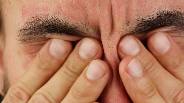 男人眨眼和抓眼睛有红色过敏反应，面部皮肤发红和脱皮银屑病，季节性皮肤病问题，特写视频素材