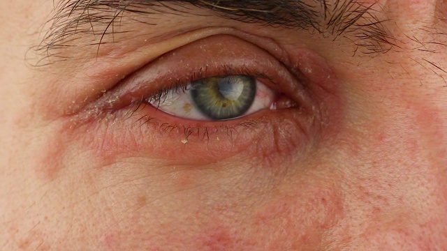 人划伤右眼有炎症和发红的过敏反应，面部皮肤发红和脱皮银屑病，季节性皮肤病问题，近景宏观视频素材