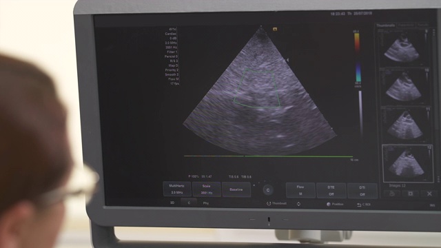 一个专业女医生做超声波检查的特写。腹部超声检查。盆腔器官在监视器上。医疗保健的概念视频下载
