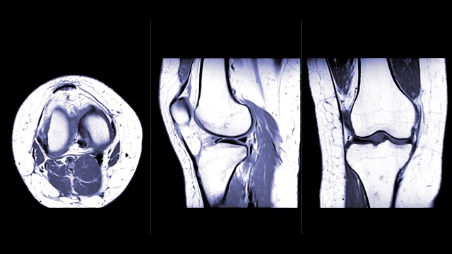 MRI膝关节或磁共振成像比较轴、矢状面和冠状面。视频下载