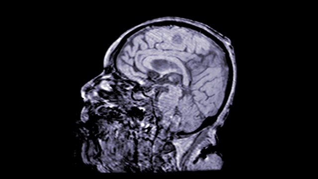 MRA大脑或磁共振血管造影的脑矢状面缓慢运动评估大脑和大脑动脉。视频下载