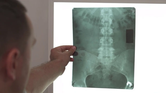 医生手持骨盆骨和人体脊柱x光片的特写。脊柱x射线视频下载