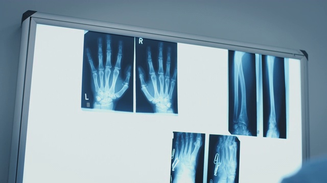 医生在医院检查双手x光图像视频下载