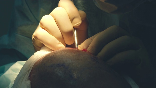 脱发的治疗。头发移植。外科医生在手术室进行头发移植手术。把毛囊从头部的一部分移走的外科技术视频素材