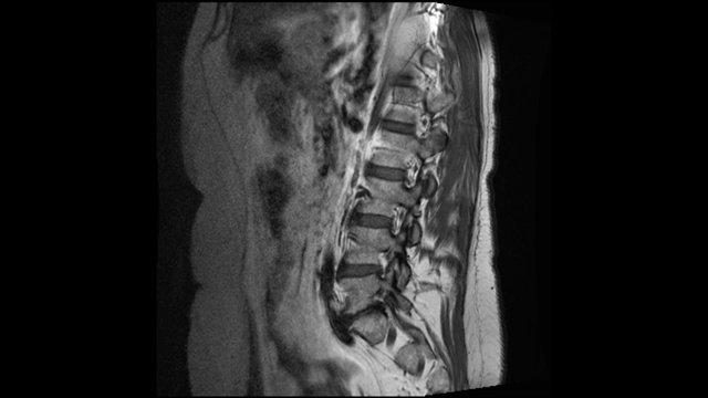 MRI显示L5-S1椎间盘突出视频下载