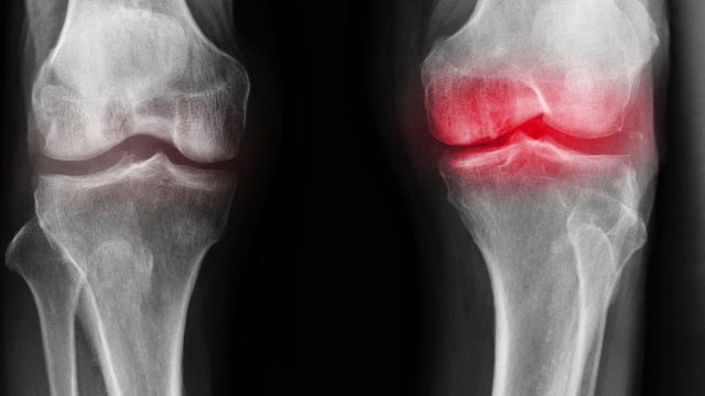 OA膝关节x线影像，有近距离膝关节和红色高光视频下载