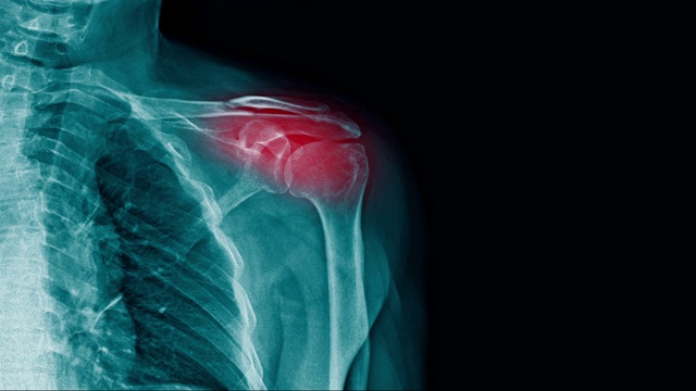 肩关节有红色高光的肩痛x光片视频下载
