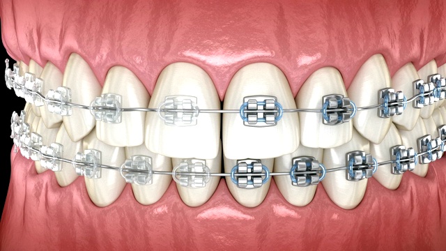 牙齿有金属和透明牙套牙龈。医学精确牙科3D动画视频下载