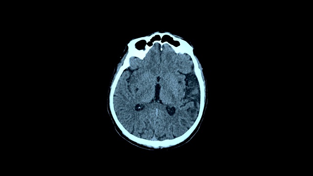 磁共振成像大脑的MRI扫描视频素材