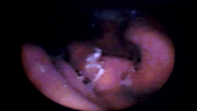 胶囊内窥镜可以看到人体消化系统的内部情况。视频下载