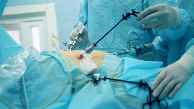 医生在腹腔镜手术中拆除手术棒视频下载