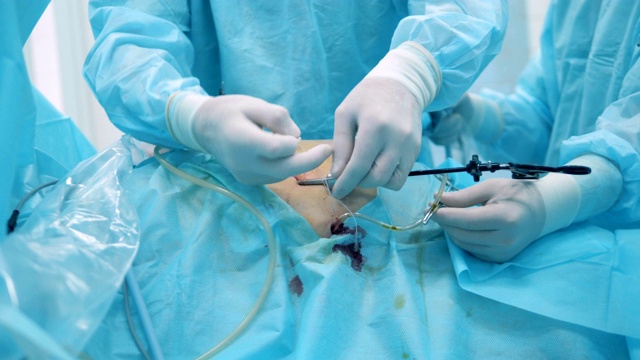 外科医生正在把一根插入人体腹部的医用导管捆扎起来视频下载